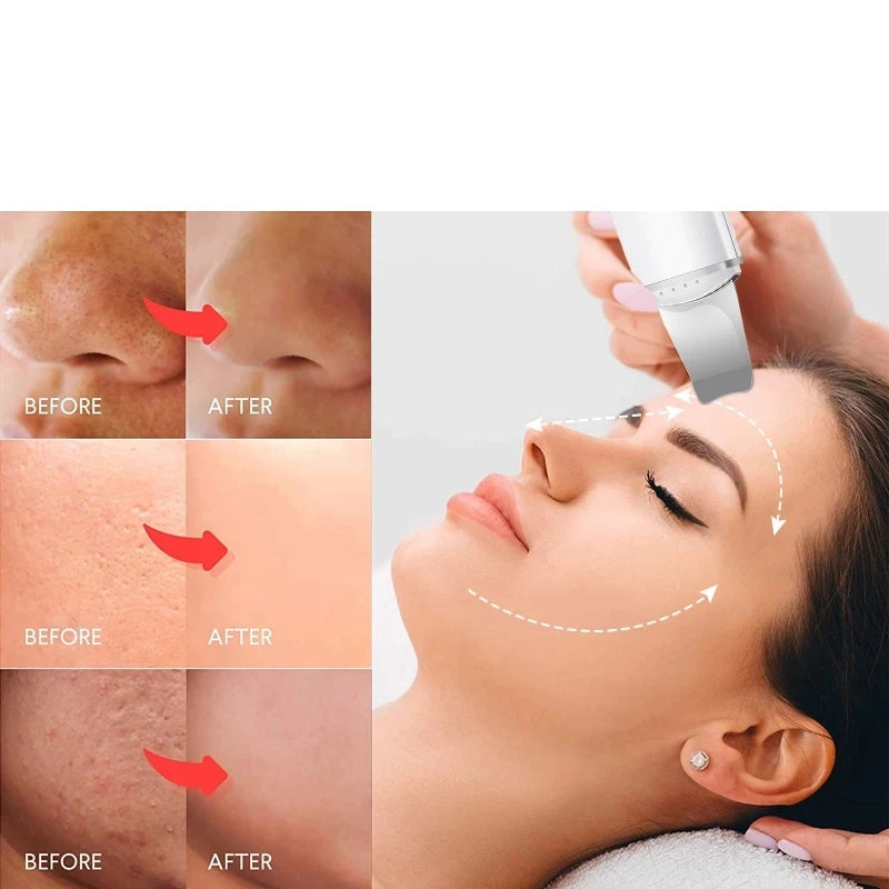 Ultrasonic Skin Scrubber